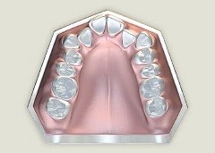 Kufizimet e drejtimit të dhëmbëve me protezë mekanike