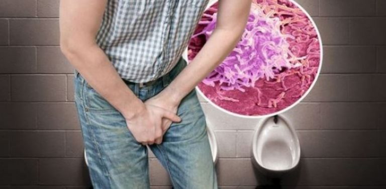 A ju ndodh kjo menjëherë pas urinimit? Mund të sinjalizojë kancerin e prostatës