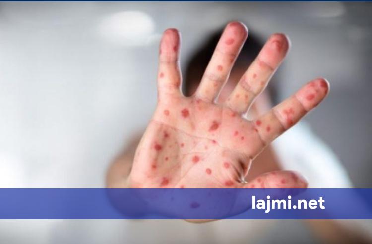 Diagnostikohet rasti i parë me fruth në Shqipëri  i infektuar një fëmijë