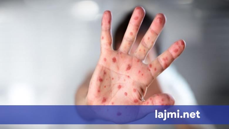 IKShPK  25 raste të konfirmuara me fruth në Kosovë  5 raste të reja javën e fundit