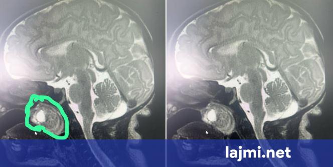 Realizohet me sukses një ndërhyrje e rrallë kirurgjikale  tumori largohet nga foshna e posalindur