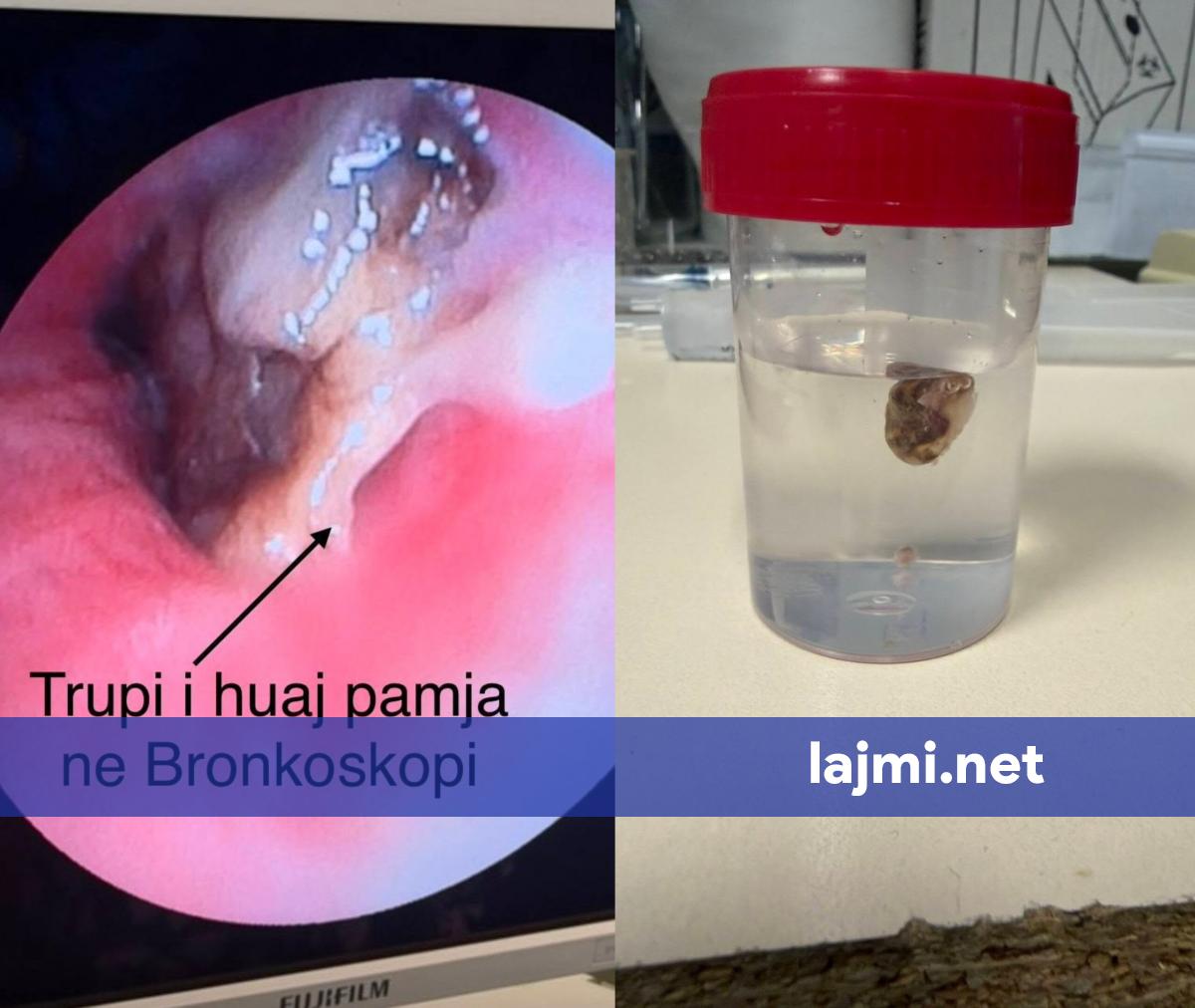 nderhyrje-e-suksesshme-urgjente-ne-pulmologjine-e-qkuk-se-i-hiqet-trup-i-huaj-pacientes-63-vjecare